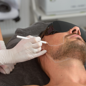 Epilazione Laser